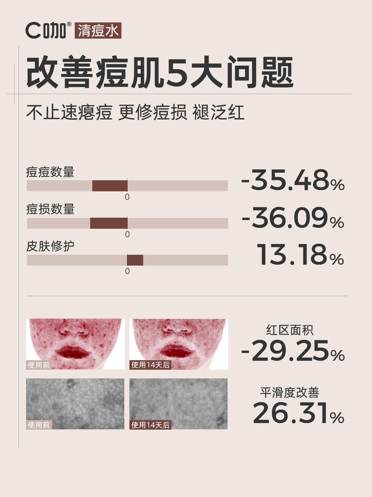 C咖 Caffeine Acne Treatment Oil-Control Repair Toner 200ml C咖净痘控油修护调理水