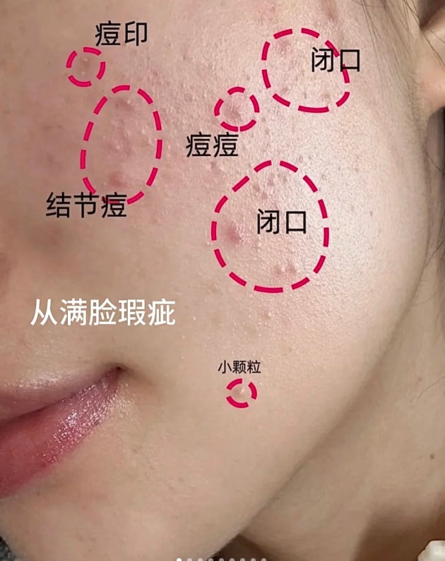 RNW Colloidal Sulfur Acne Powder Essence 10ml 如薇胶态硫祛痘粉精华液