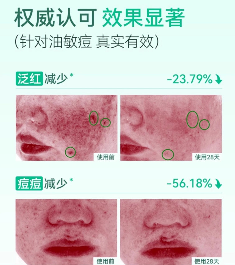Tiktok/Douyin Hot Yin Shi Gentle Acne Treatment Serum 15ml【Tiktok抖音爆款】 因士柔酸祛痘精华液
